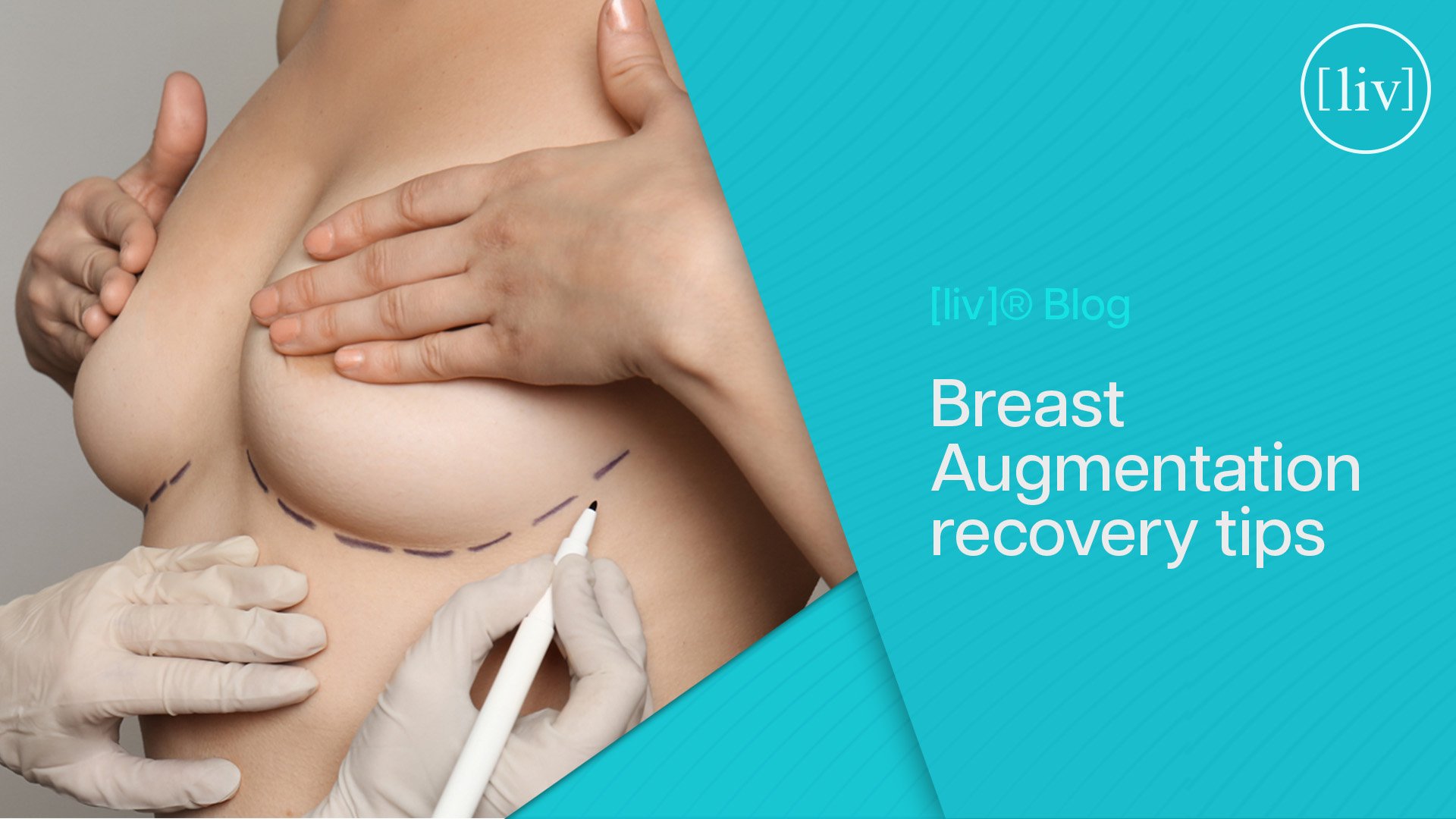 Breast Augmentation Recovery Week by Week